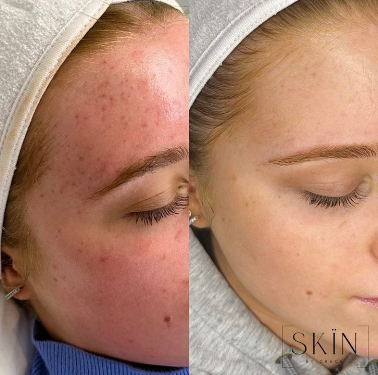 Loss of Collagen & Firmness